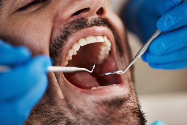 Best Emergency Wisdom Teeth Removal in Brookside Village, TX