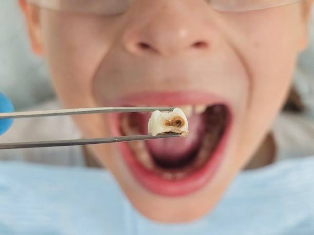 Best Emergency Tooth Extraction in Brookside Village, TX